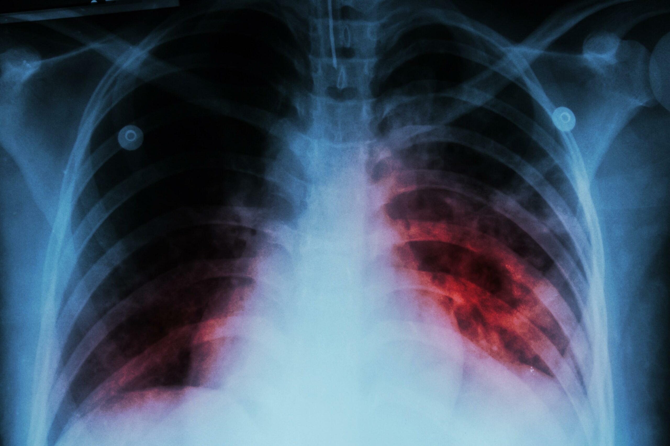 In Ghana, TB claims 30 lives per day.