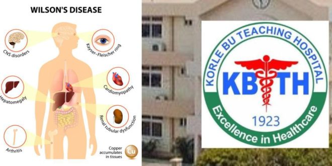 Ghana Records First Case of Wilson’s Disease at Korle Bu Teaching Hospital